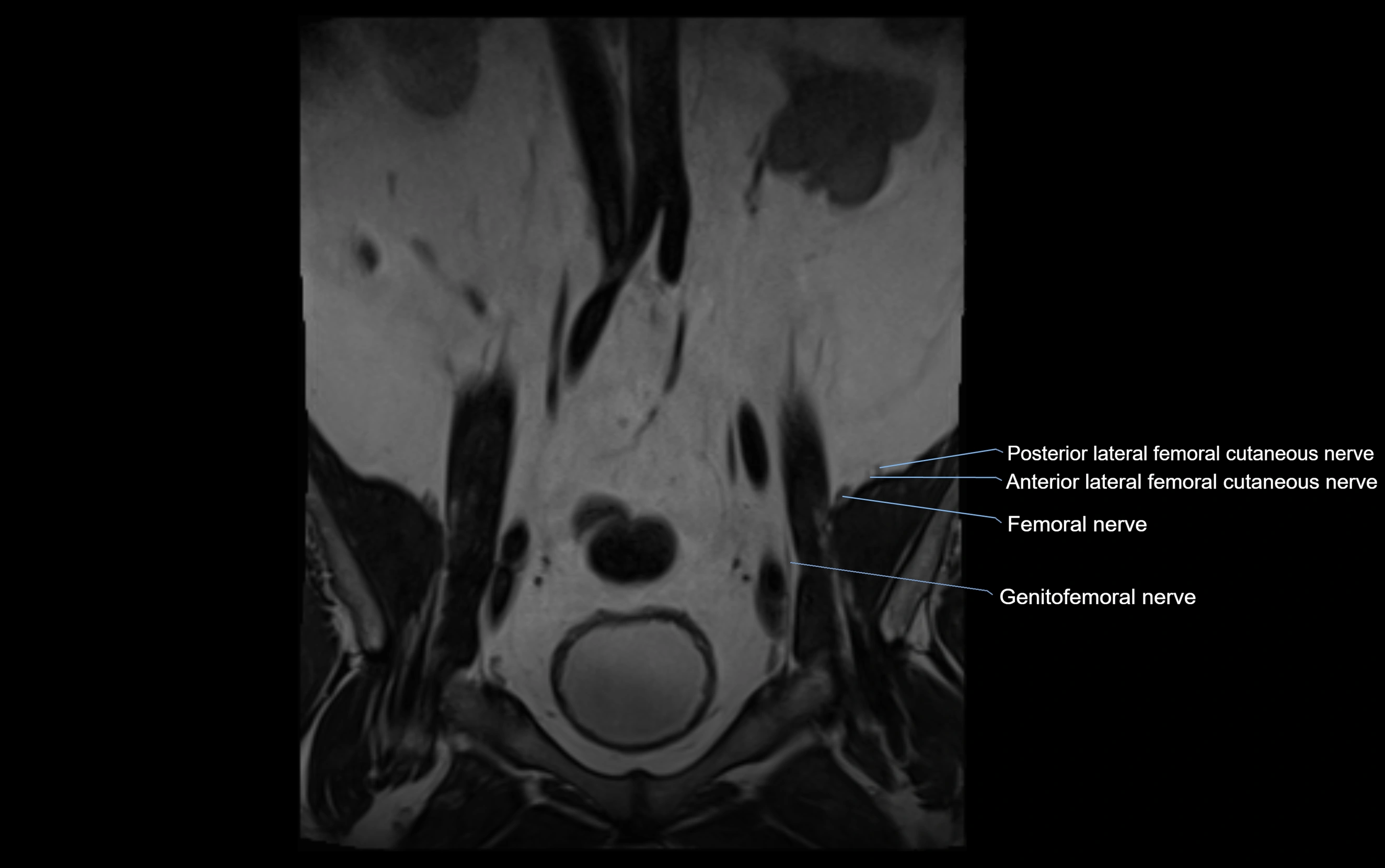 MR lumbosacral plexus cross sectional anatomy 3T  radiology  image-img-09001-00002.webp